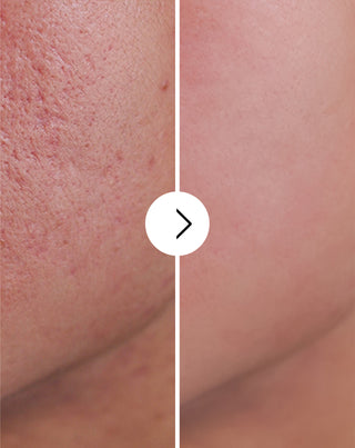 Таблетки против акне, пъпки и несъвършенства с цинк, витамин C, E и B2 Derminax_4 - 4