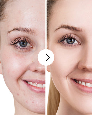 Таблетки против акне, пъпки и несъвършенства с цинк, витамин C, E и B2 Derminax_5 - 5