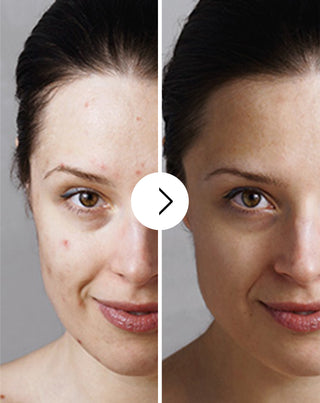 Таблетки против акне, пъпки и несъвършенства с цинк, витамин C, E и B2 Derminax_3 - 3