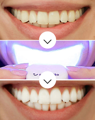 Комплект за избелване на зъби с LED лампа и избелващ гел Light & Bright Smilebite - 3